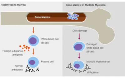 Multiple Myeloma