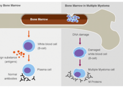 Multiple Myeloma